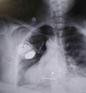 An x-ray showing the defibrillator in Miller's chest